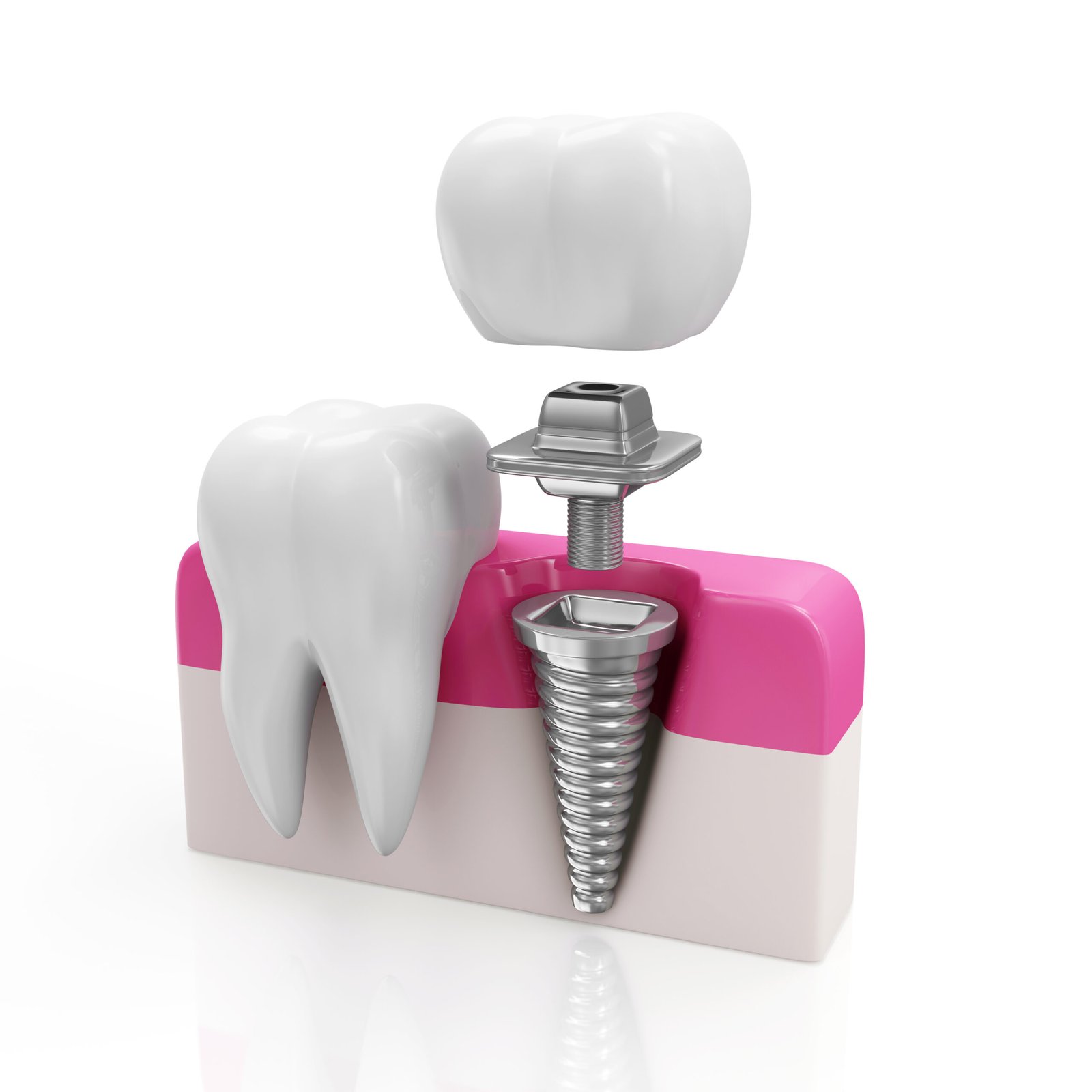 dental implant 