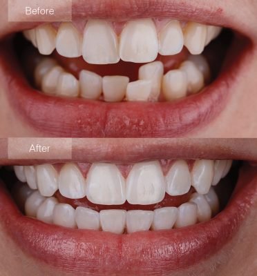 Clear Aligners in dubai