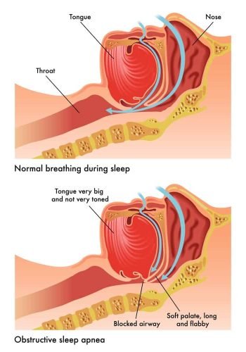 Snoring & Sleep Apnea Treatment in dubai uae