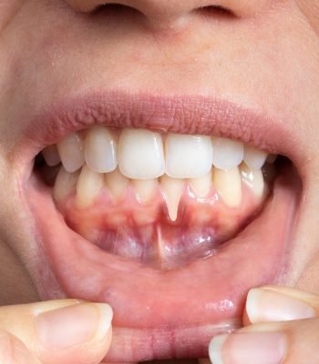 teeth-gum-close