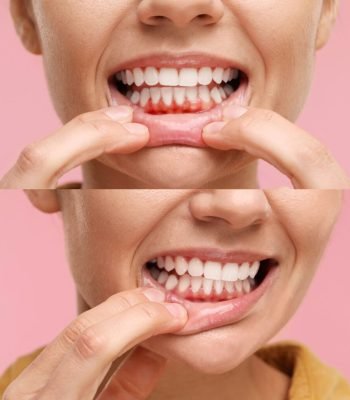 Woman,Showing,Gum,Before,And,After,Treatment,On,Pink,Background,